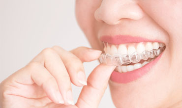 Teeth Aligners / Orthodontic Treatment